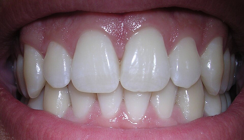 {{center|Healthy human teeth}}