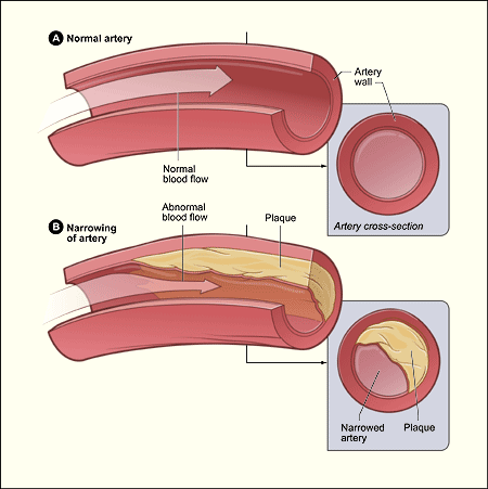 {{Center|Diagram showing the effects of atherosclerosis on an artery.}}