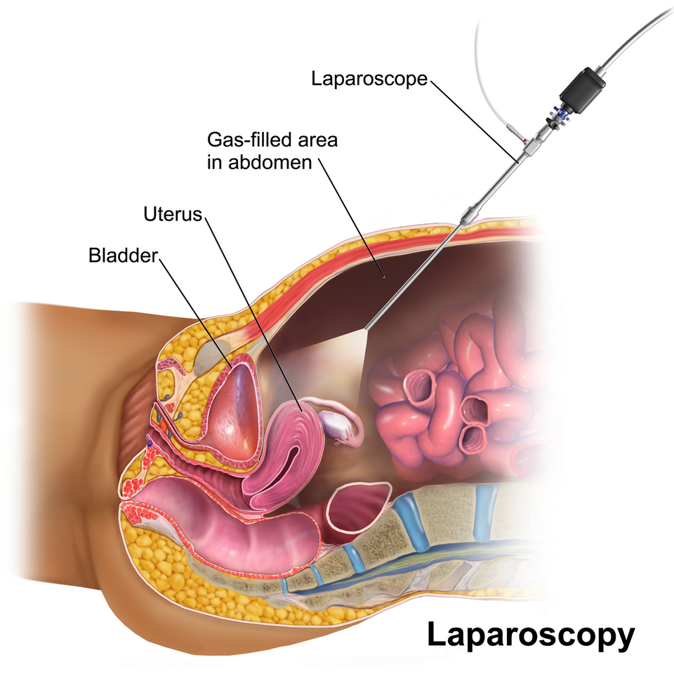 Medical - Laparoscopic Surgery
