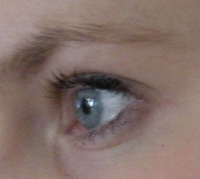 The pupil and iris are seen through the cornea.