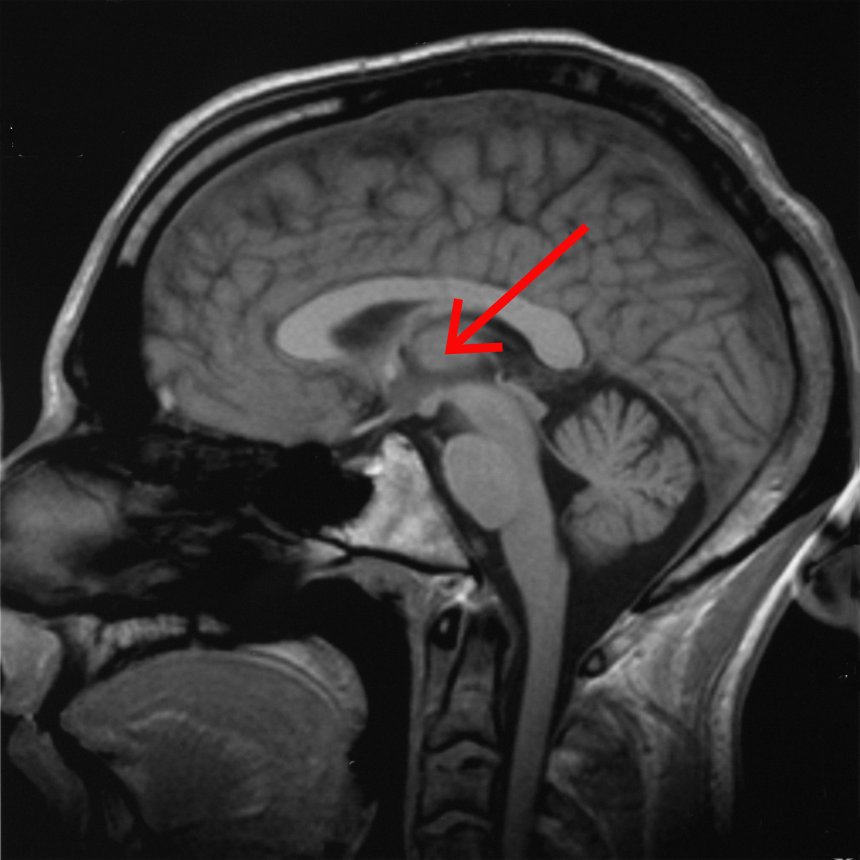 MRI cross-section, with thalamus marked