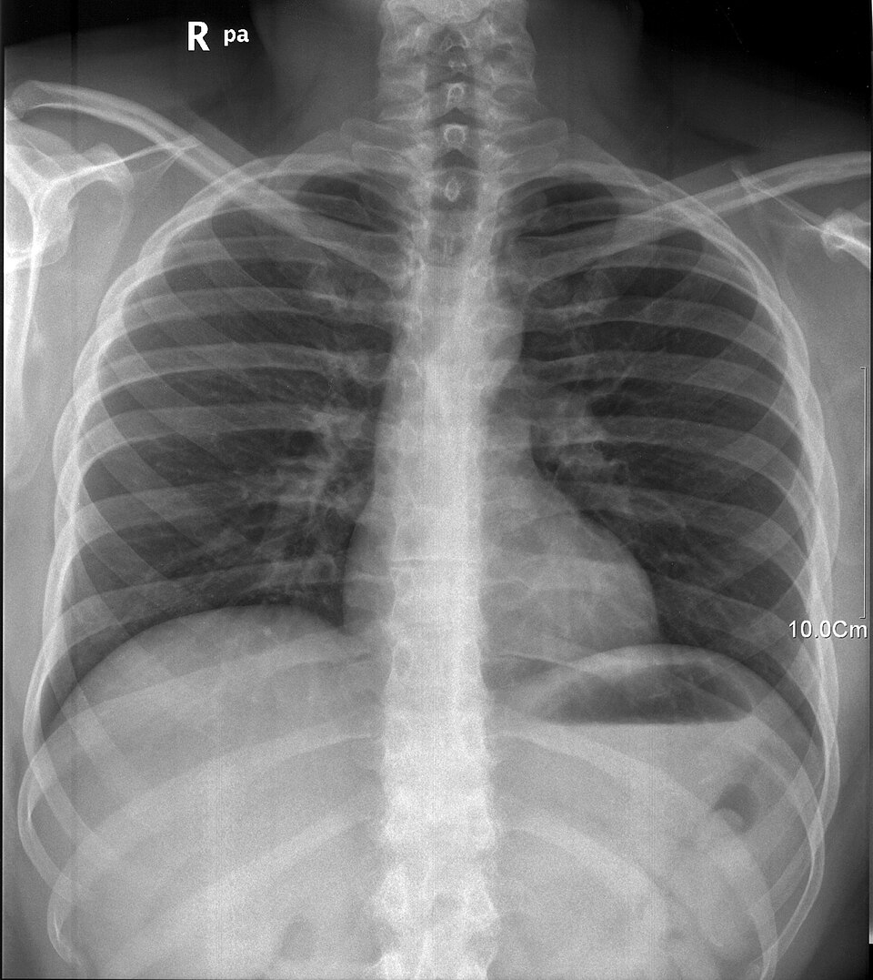 An X-ray photograph of a person's lungs.