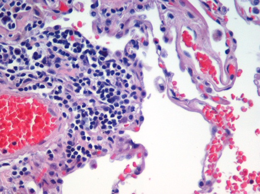 Microscopic view of a histologic specimen of human lung tissue stained with haematoxylin and eosin.