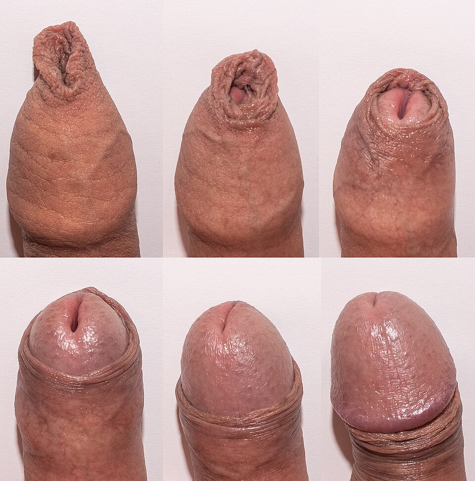 Foreskin retraction series from fully covering the glans to completely pulled back.