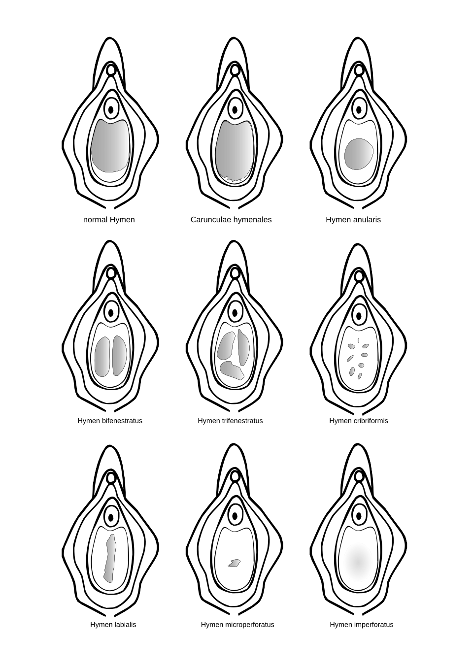 Various hymen defects (the shaded areas represent the vaginal opening
