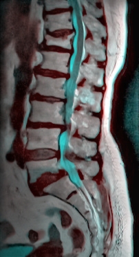 An MRI of the human spine. The part in blue is the spinal canal. It also shows that one vertebra has been broken (L-3), which means that the spinal cord is compressed at one point (L-3,L-4 impingement) .