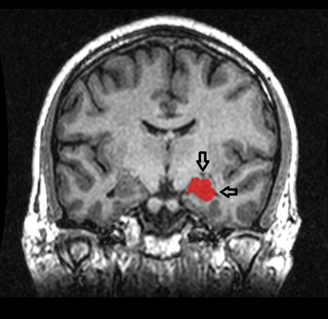 MRI coronal view of a hippocampus shown in red
