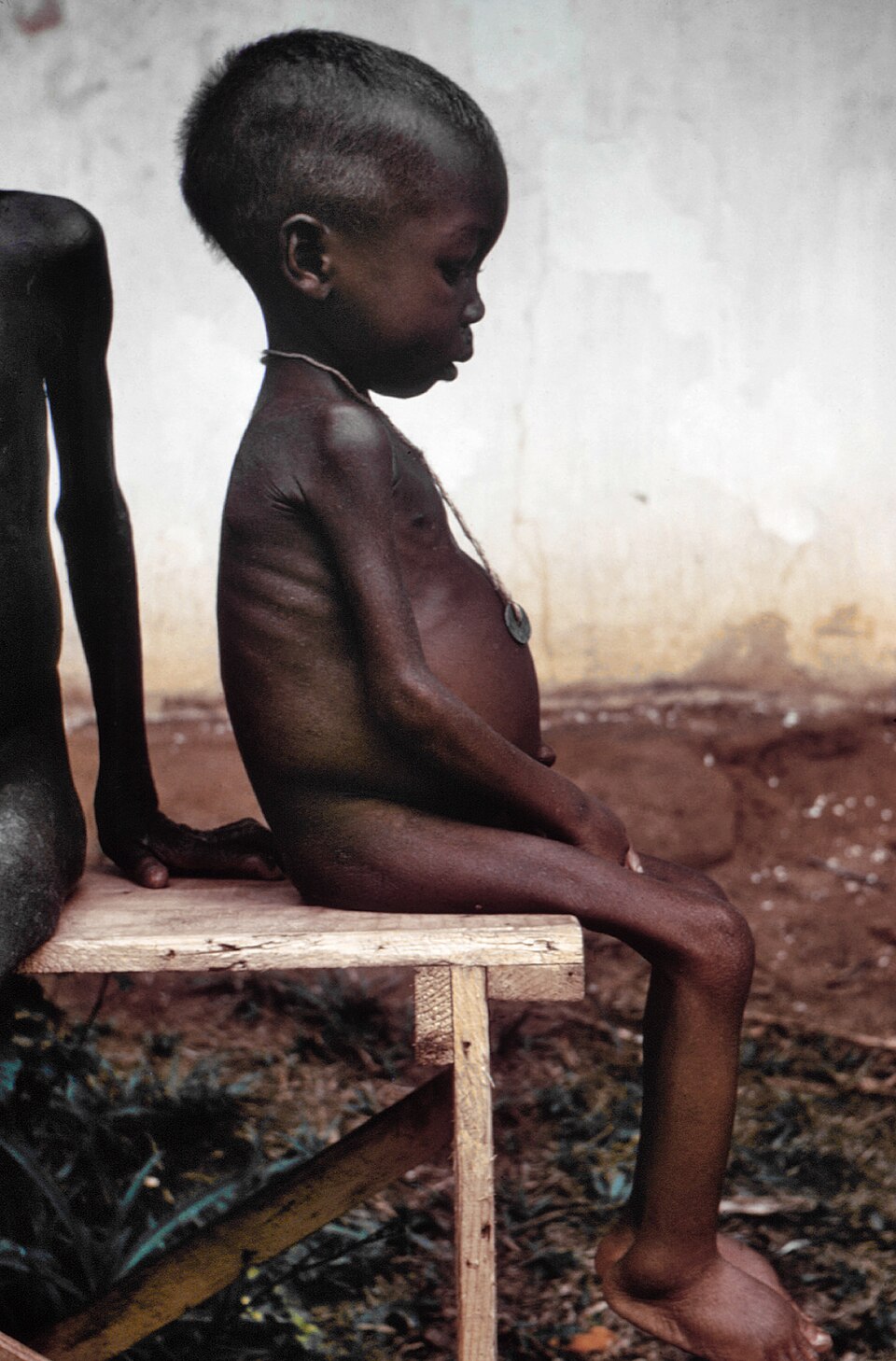 A child suffering the effects of severe hunger and malnutrition during the Nigerian blockade