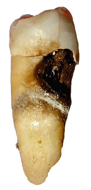 {{center|A diseased tooth with dental caries}}
